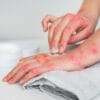 Benefits of CBD for Eczema Relief