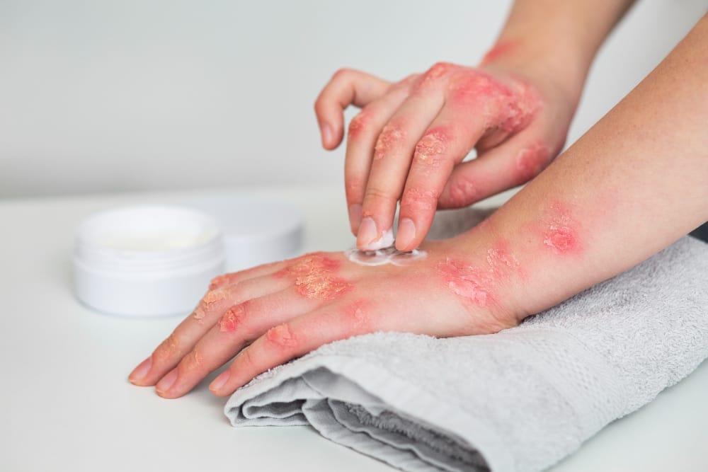 Benefits of CBD for Eczema Relief